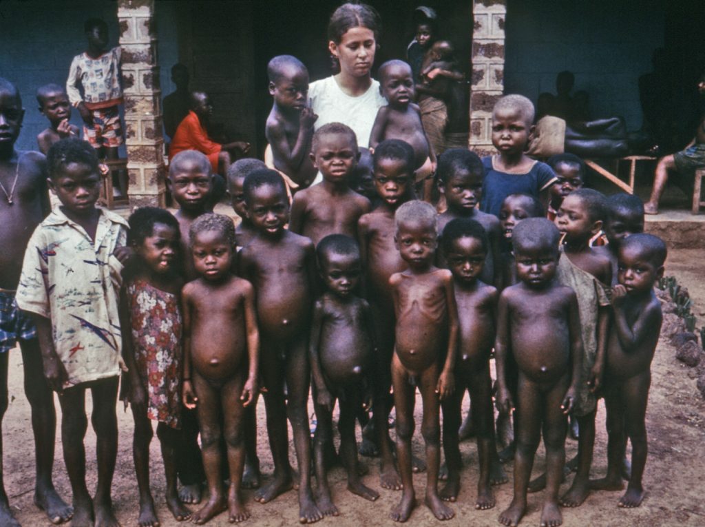 Children with Kwashiorkor