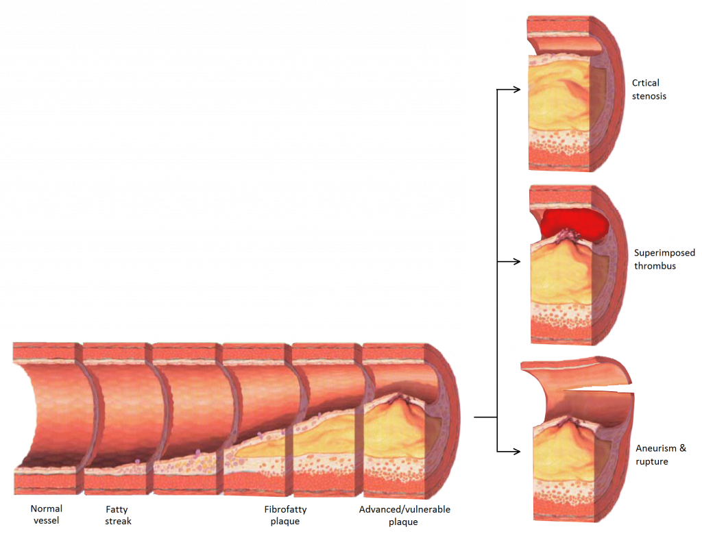 Diagram showing the progression of atherosclerosis to late complications.