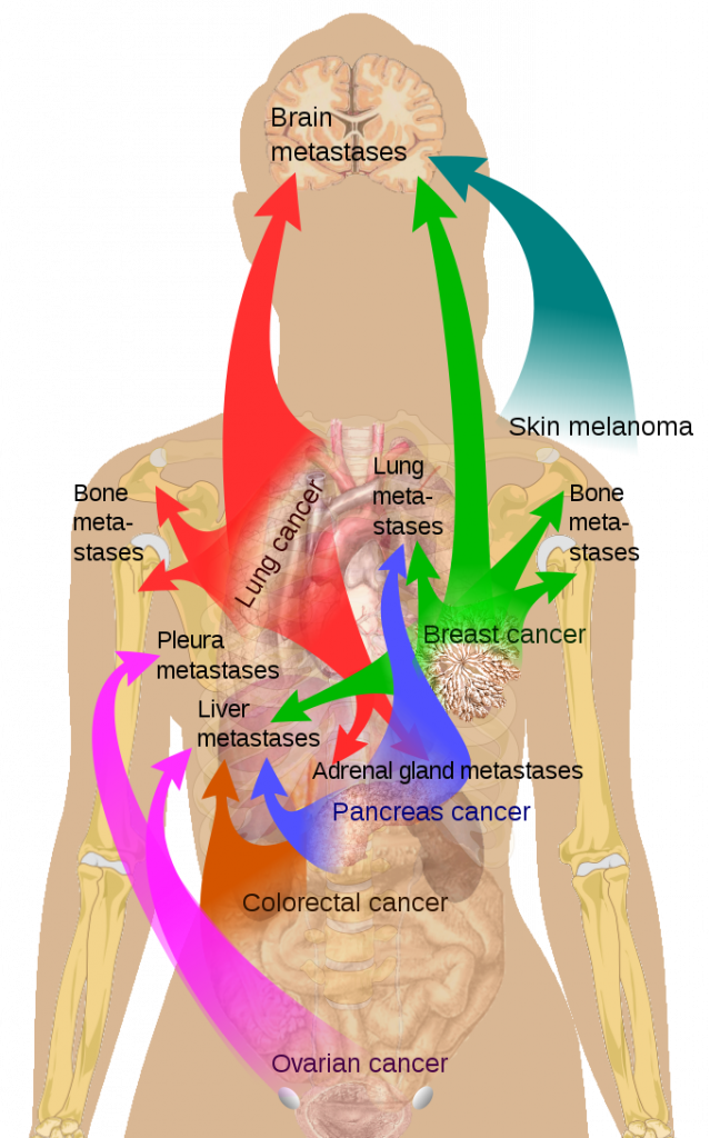 Diagram showing the main sites of metastases for some common cancer types.