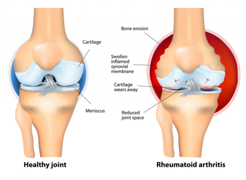 Diagram showing a normal joint versus a joint affected by rheumatoid arthritis.