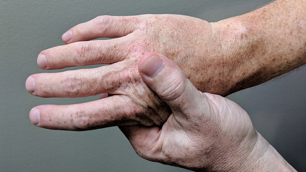 A hand with arthritis