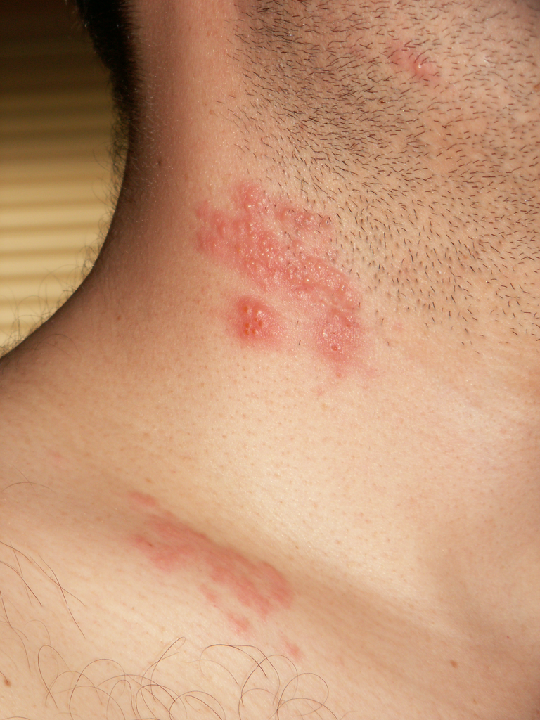 Shingles rash on neck