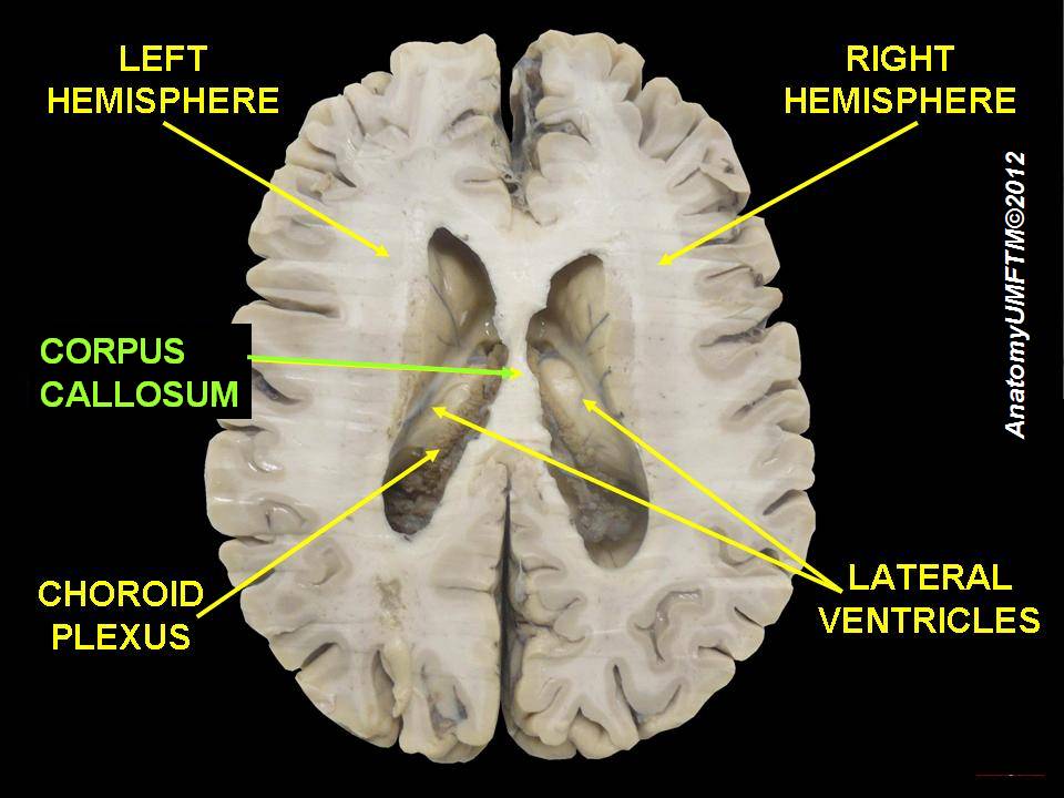Horizontal section of the brain labelling the corpus callosum