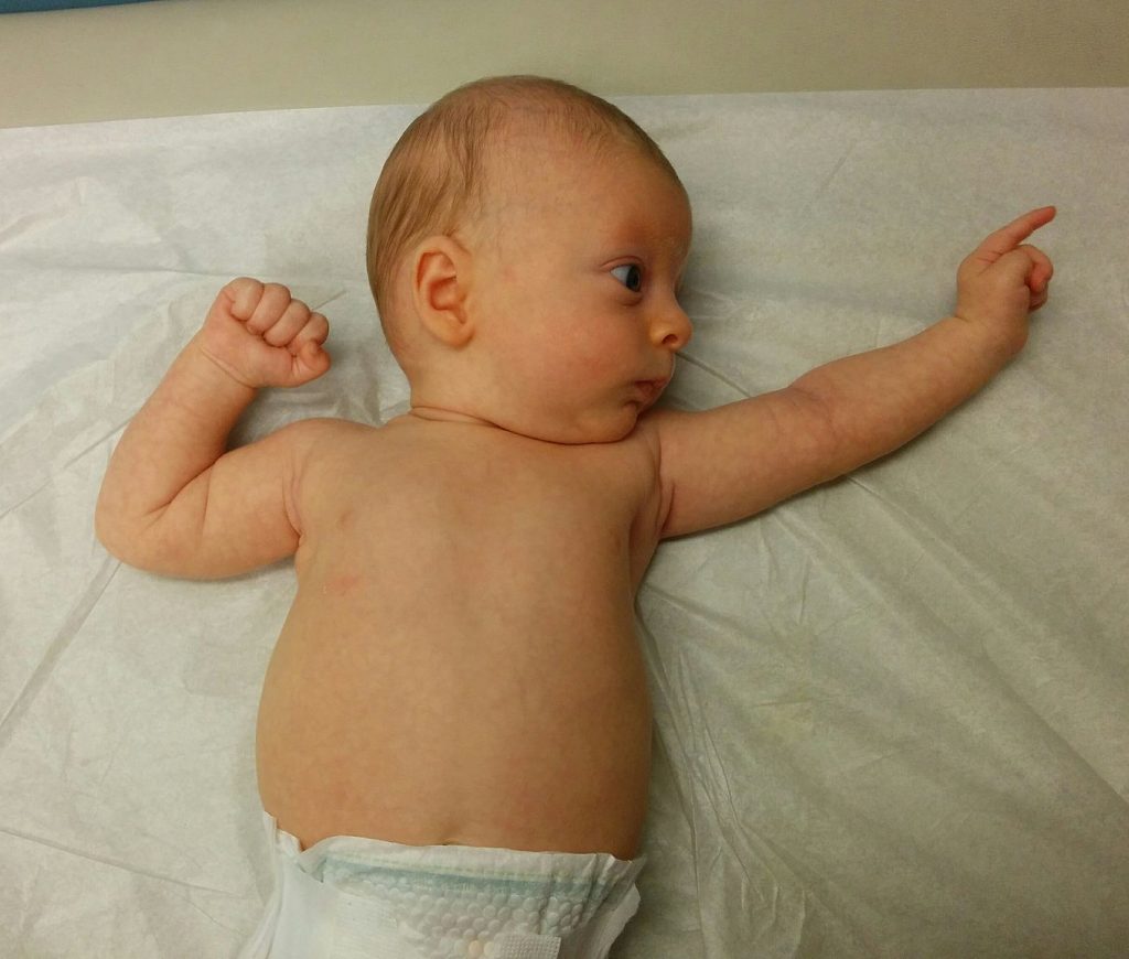 A baby displaying the tonic reflex